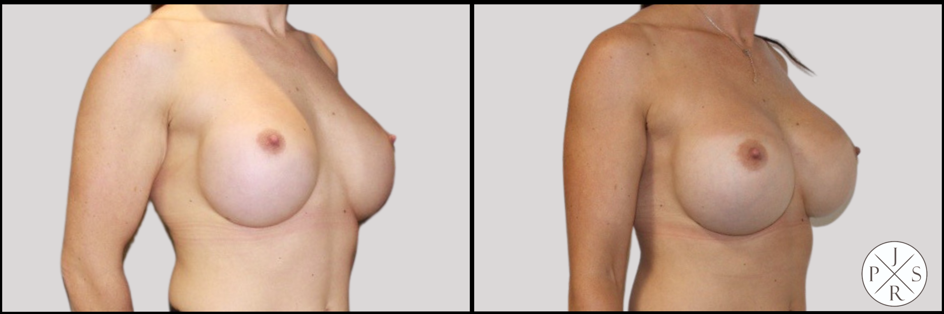 Breast Revision Before & After Image